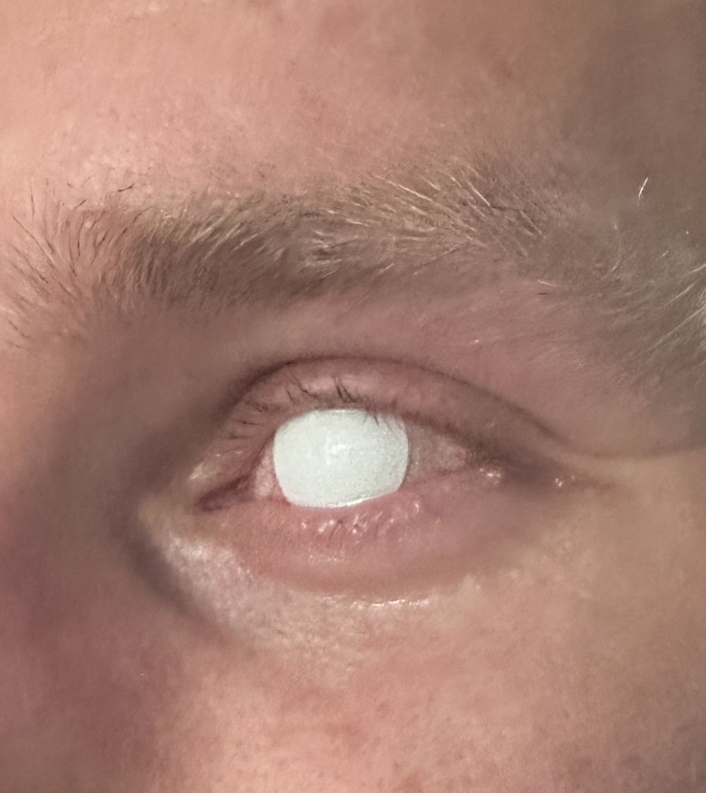 Crazylinser Blind White